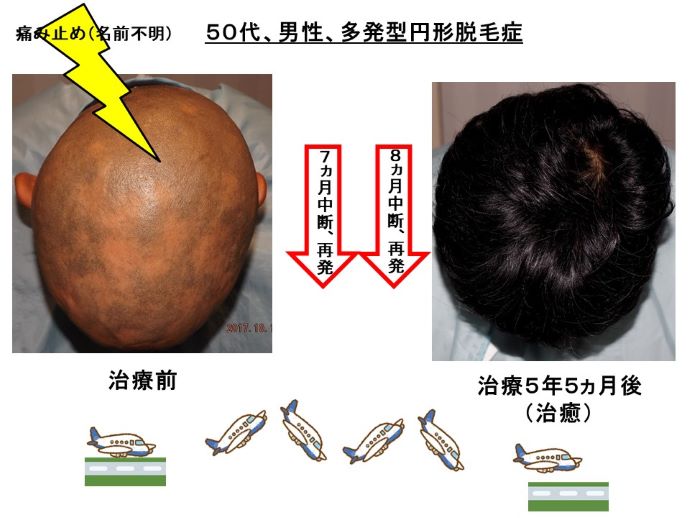 円形脱毛症　病院